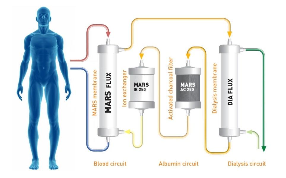 Illustration of the MARS system extracorporeal toxin removal